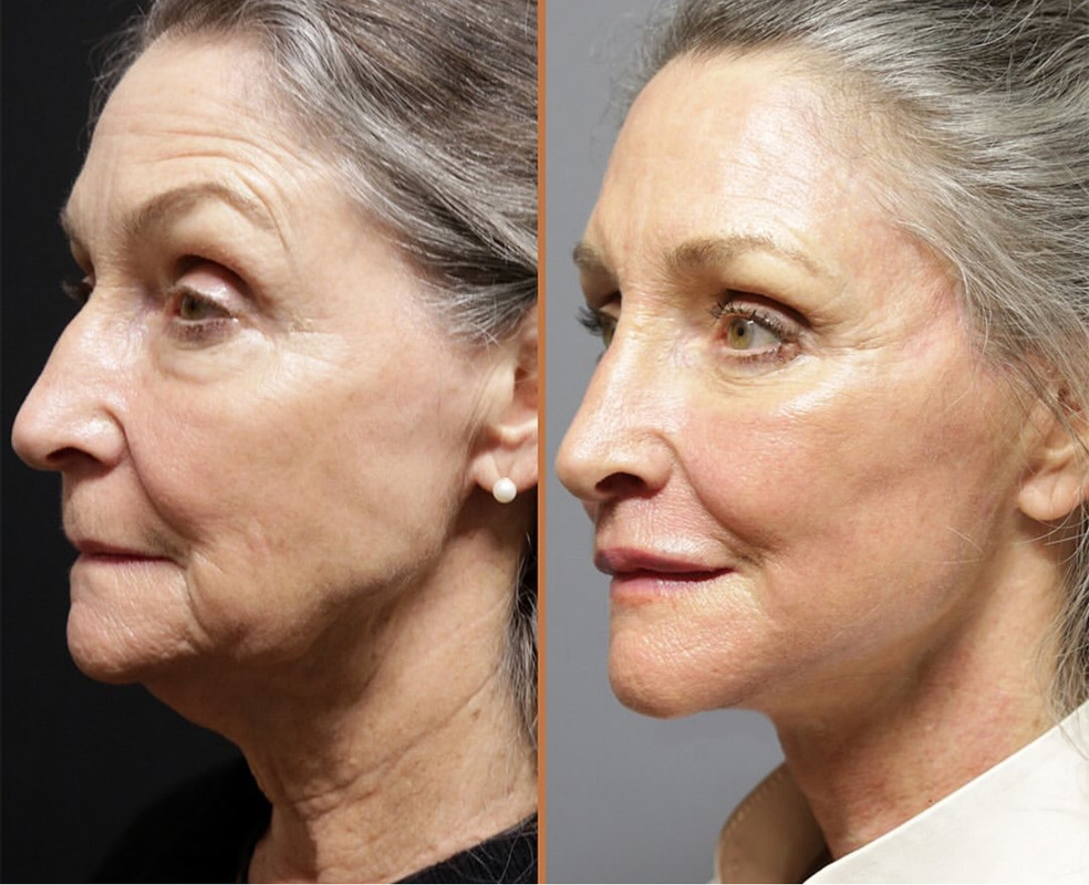 Résultat peau – glow naturel