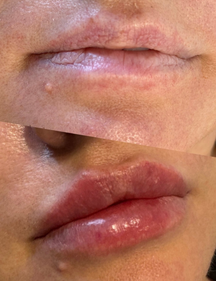 Lip Filler Enhancement