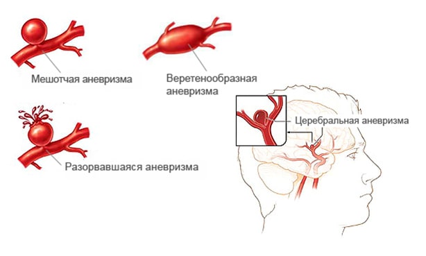 Аневризма вен