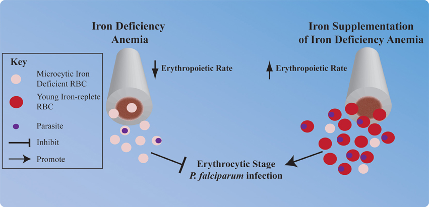 Anemia from Malaria and Iron Deficiency