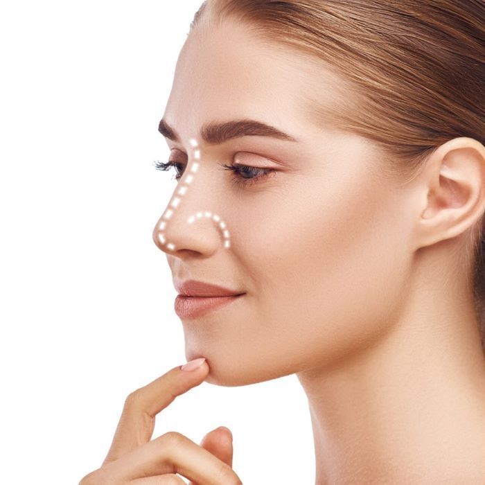 Rhinoplasty
