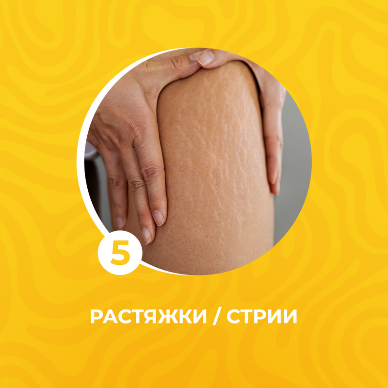 Растяжки / стрии