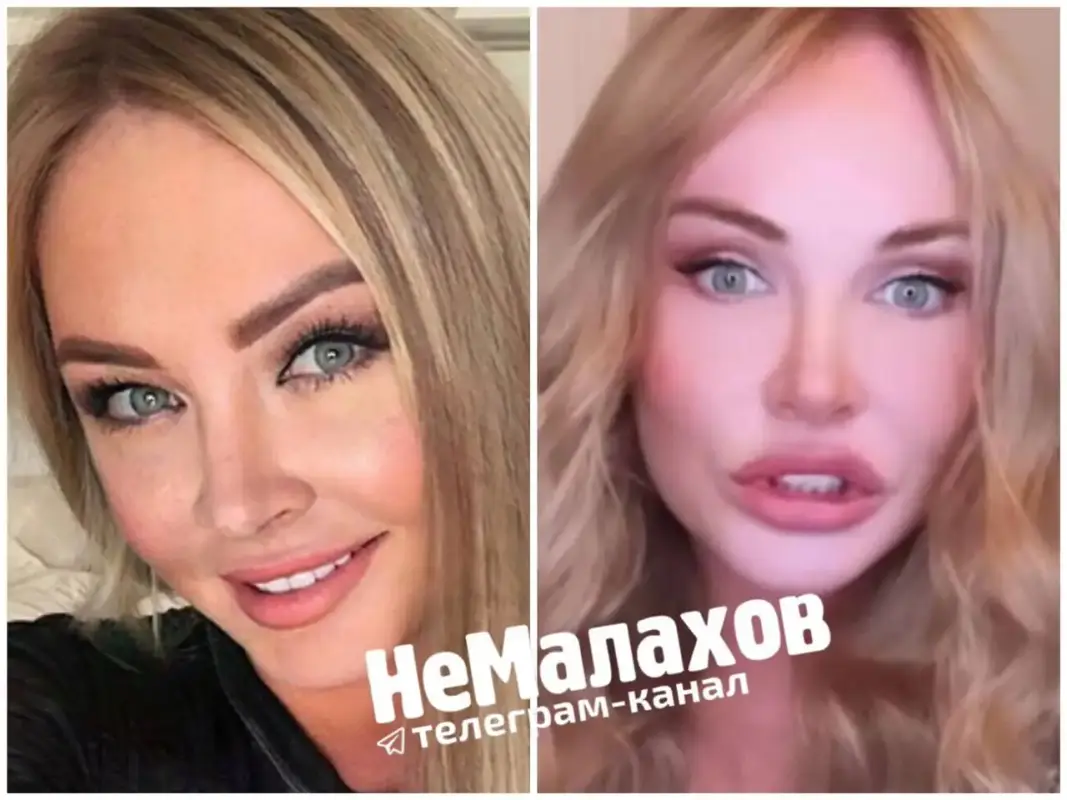 Даша пынзарь до и после пластики фото