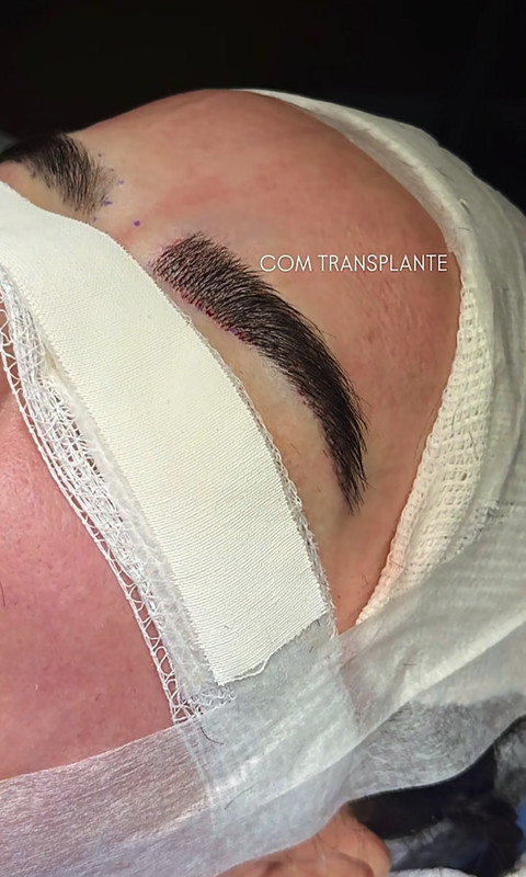 Resultado de transplante de sobrancelhas 6