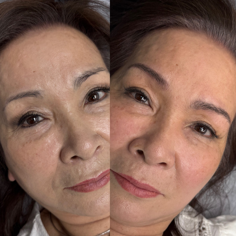 Eyebrow Enhancement Example New 5
