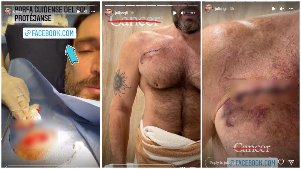 Julián Gil confiesa que tiene cáncer de piel ¿Cómo se encuentra?