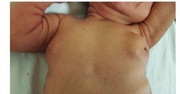 Neonatal breast enlargement - bilateral subareolar swelling, physiologic gynecomastia