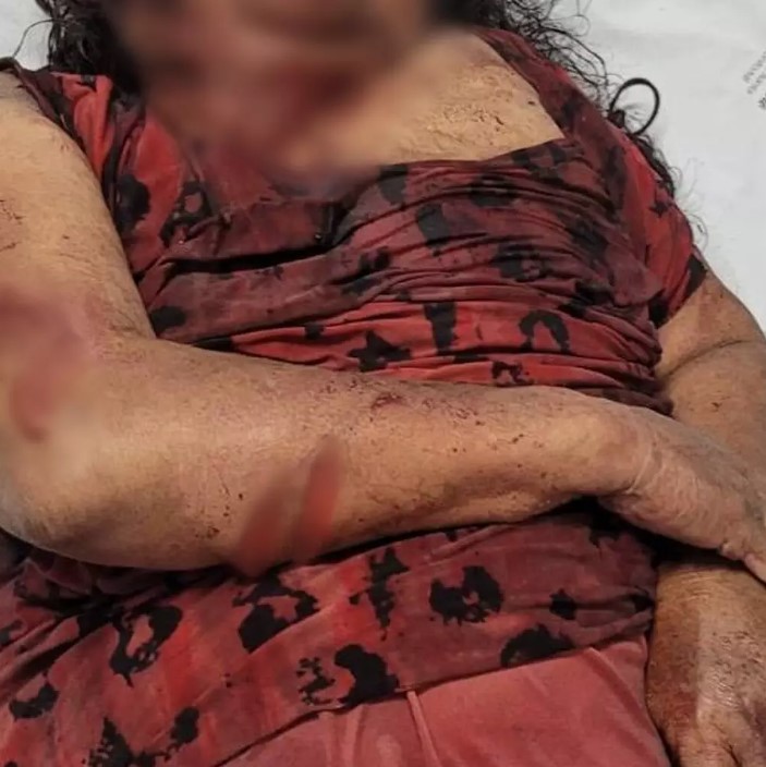 Idosa com ferimentos pelo corpo após ser socorrida. (Foto: Direto das Ruas)
