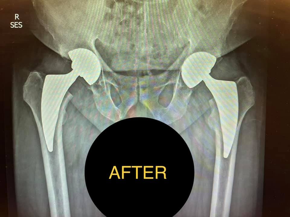 Hips x-ray After
