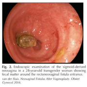 tranny fecal  neovagina