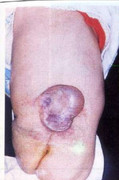 Myelomeningocele - sacral/lumbar cystic lesion with neural placode, covered by thin membrane