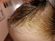 לפני הטיפול