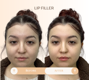 Lip filler before and after result