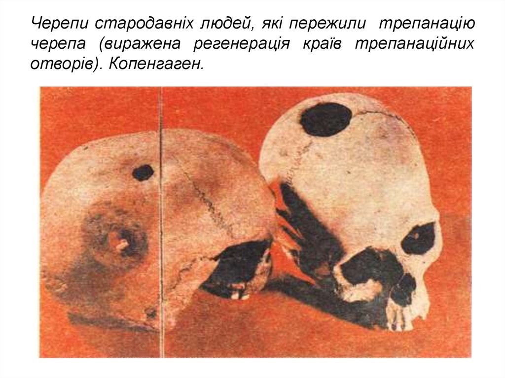 Zalužnui buvo atlikta kraniotomija (kaukolės trepanacija)