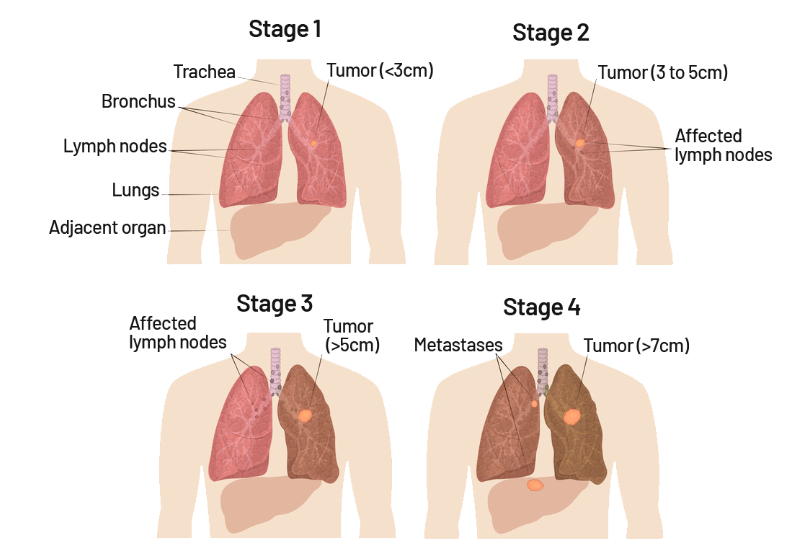 Lung Cancer Stages Diagram