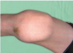 Clinical photograph showing a swollen, tender, and warm knee joint (hemarthrosis) in a patient with hemophilia