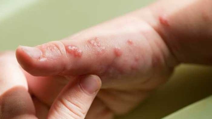 Ya son 131 casos confirmados de viruela del mono en todo el mundo