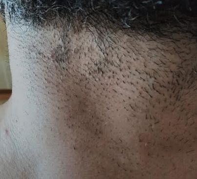 HELP!!! Danni da epilazione laser sulla barba c'è modo di recuperare entro  breve tempo? | Ieson Forum
