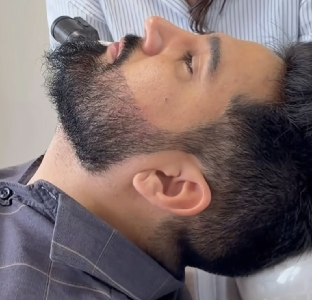 Resultado de transplante de barba 4