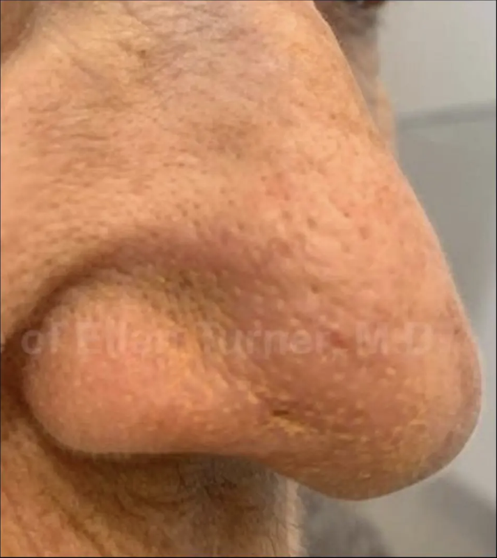 After Superficial Radiation Therapy