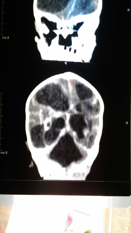 мультикистоз