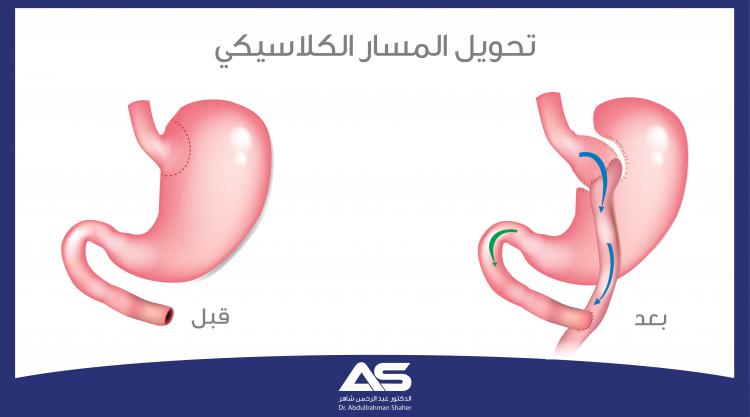 جراحة تحويل المسار الكلاسيكية Roux-en-Y وصفها وخطواتها، ومراحل ما قبل وبعد العملية