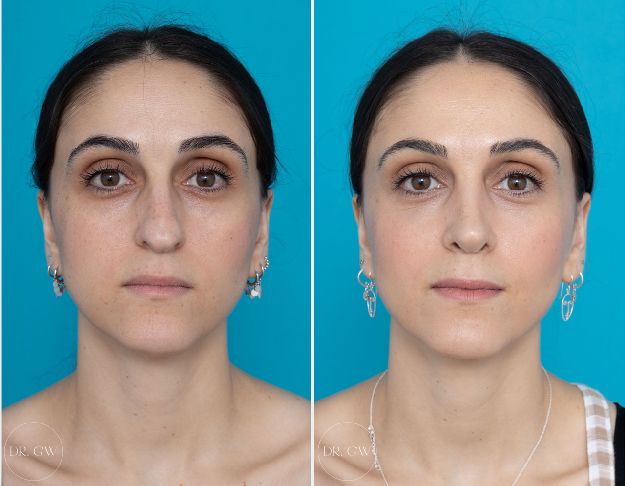 Rhinoplasty result