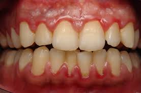 Gingivitis