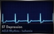 ST depression