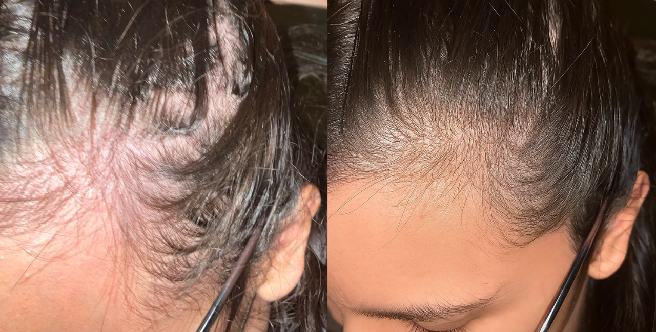 Resultado Suelen - Antes e Depois O-Xidil