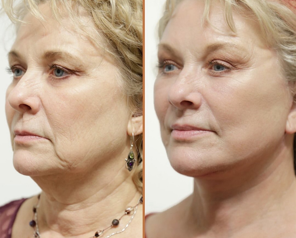 Résultat peau – lissage visible