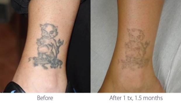 ClearLift before and after result at Let's Face It Med Spa in Denver.