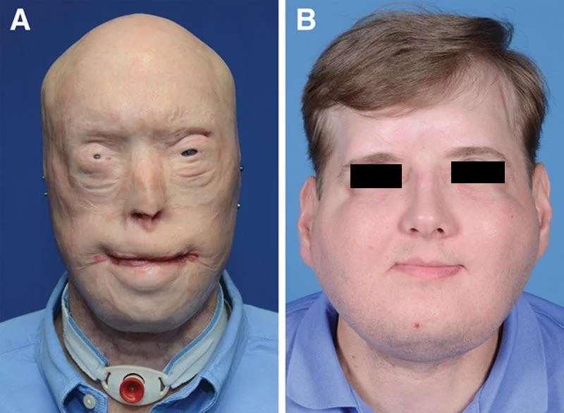 facial-transplant