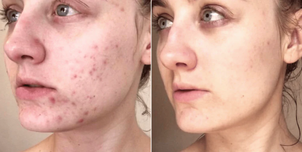 Clinical Before and After Results