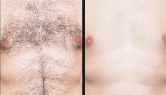 laser hair removal in North York laser-hair-removal-in-North-York