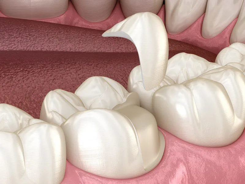 Mechanical Stress Distribution in Chipped Porcelain Crowns