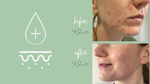 Adult Acne: Skincare For Clear Skin