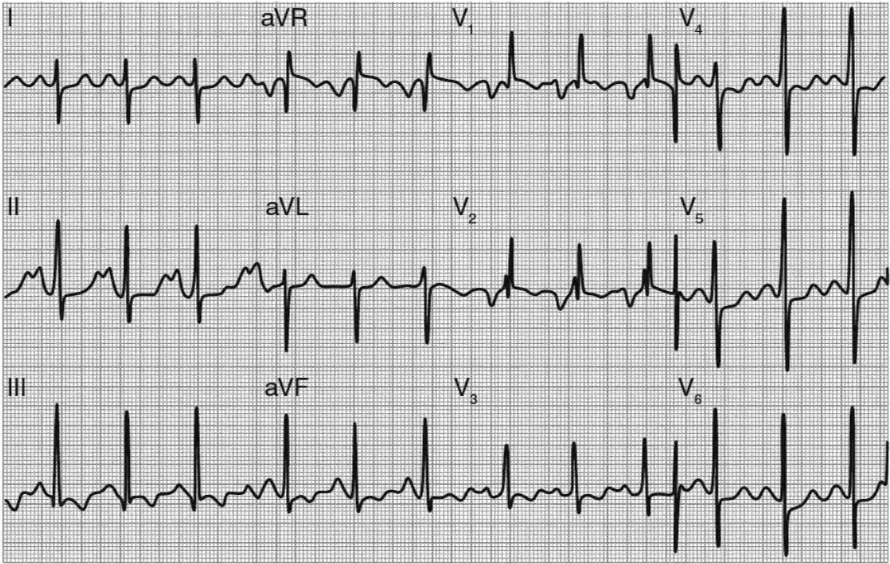 ЭКГ при изолированном МС и синусовом ритме