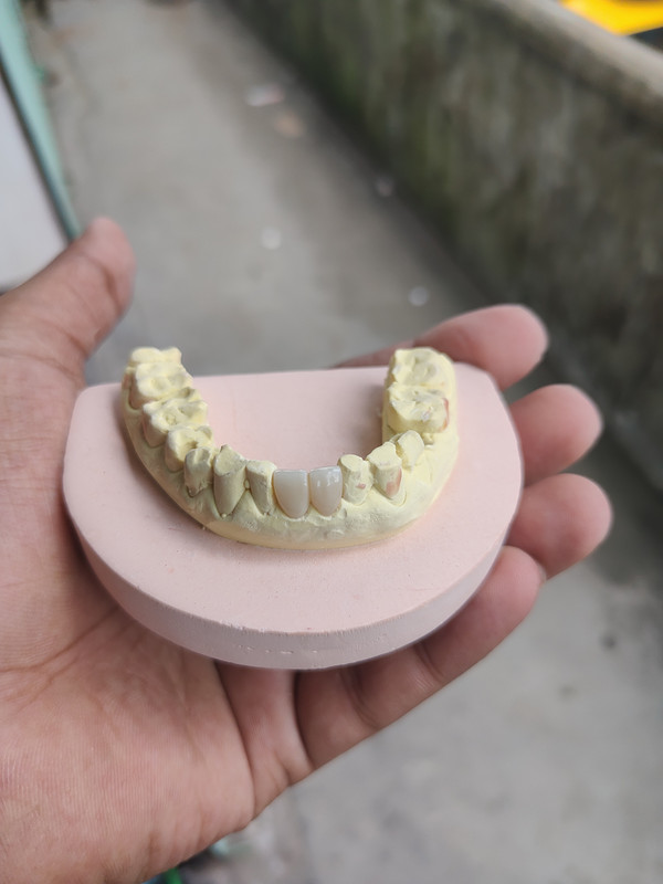 জিরকোনিয়া ক্রাউন লাগানোর আগে দাঁতের ডাইসের উপরে