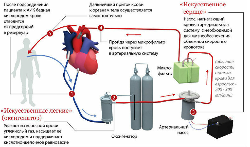 Artificial Circulation of Blood, Mans Stock Footage Video (100%  Royalty-free) 28109524 | Shutterstock