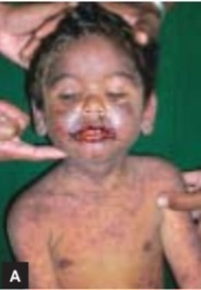 Targetoid lesions, diffuse rash, and severe oral mucosal ulceration with hemorrhagic crusts in Stevens-Johnson syndrome