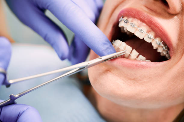 Affordable Braces Treatment in Goshen