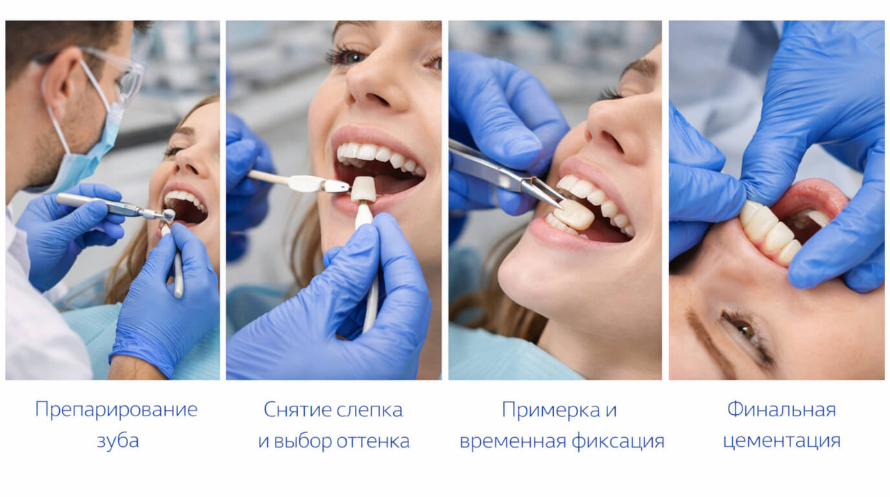 Этапы установки керамических коронок