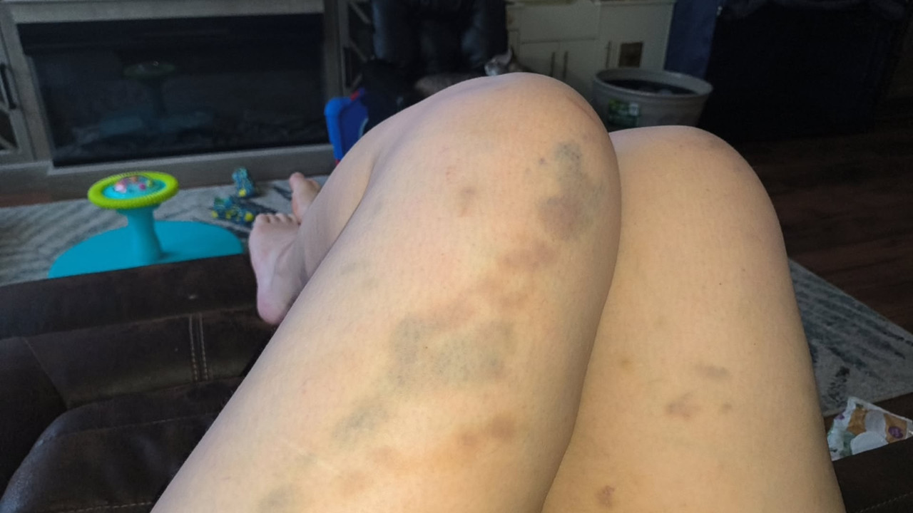 Bruises after sleeping