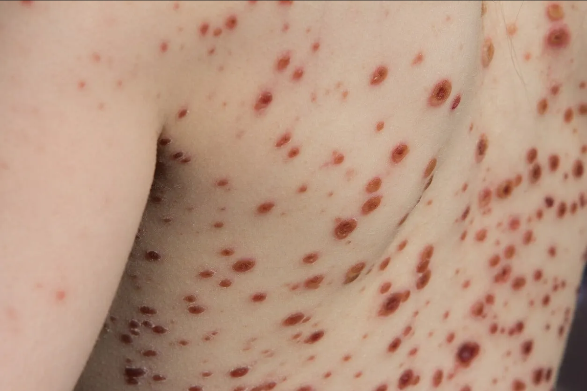 Repuntan casos de viruela del mono y encienden las alarmas a nivel mundial