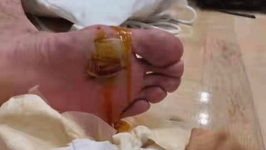 foot-blisters-from-chen-long-2020-tokyo-olympics.png