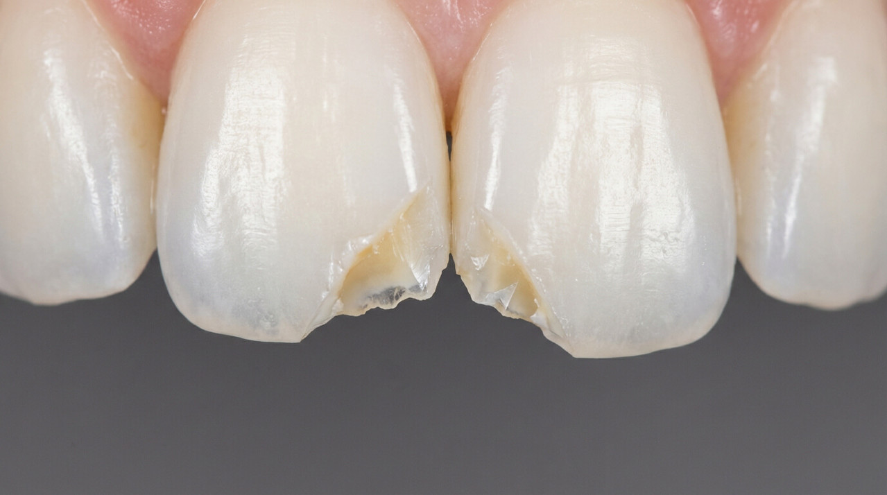 Скол переднего зуба на фото