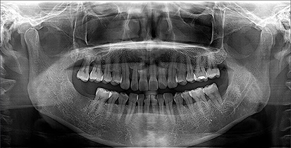 OPG & IOPA X-ray Imaging