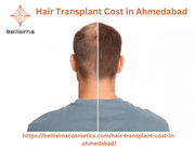 Hair Transplant Cost in Ahmedabad
