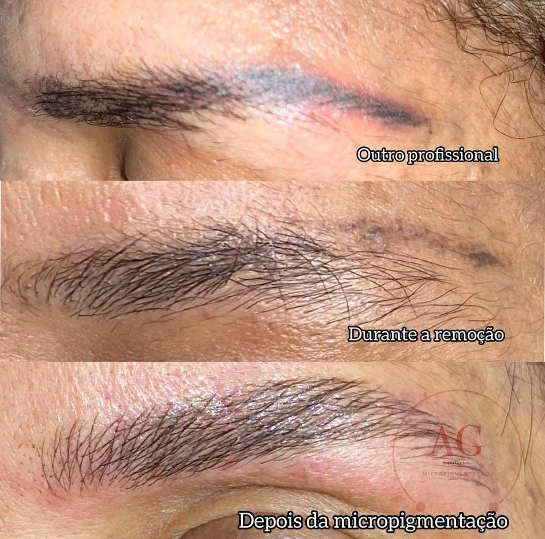 Resultado sobrancelhas